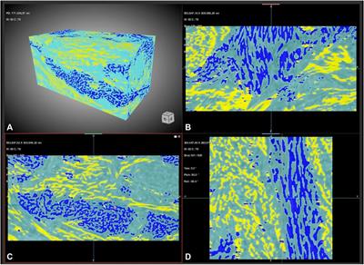 Unraveling the biomechanical properties of collagenous tissues pathologies using synchrotron-based phase-contrast microtomography with deep learning